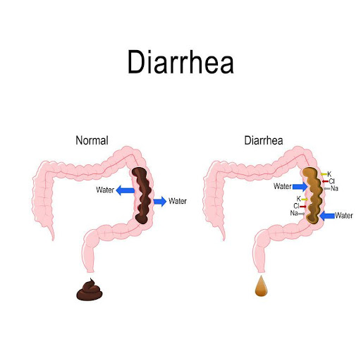 diarrhea