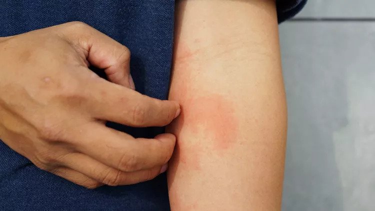 Eczema-Atopic-Dermatitis